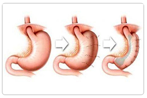 laparoscopic gastric plication