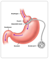 gastric band